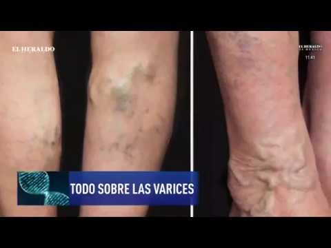 Cómo controlar las várices, consejos del doctor Juan Francisco Flores