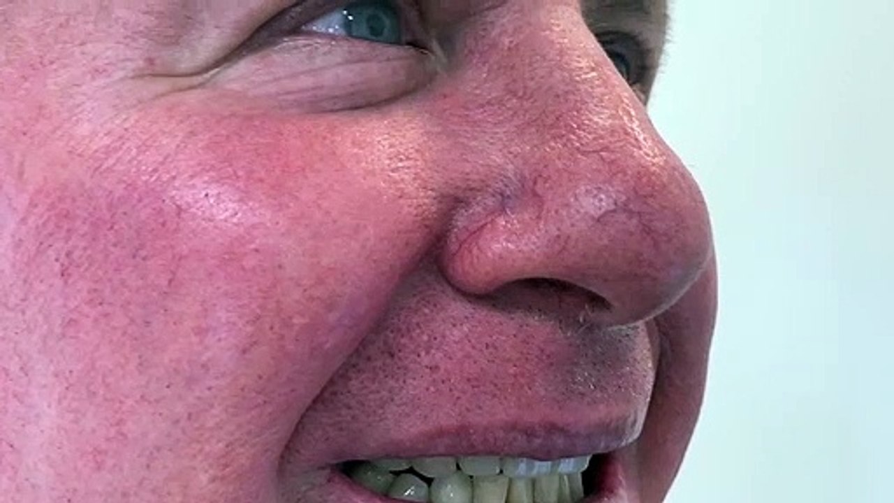 Smile Designing with Ceramic Crowns at Healthy Smiles