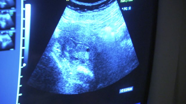 '자궁 외 임신'도 다음 달부터 건강보험 진료비 지원 / YTN