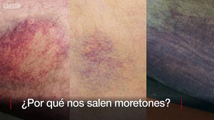 Tecnología y ciencia | ¿Por qué nos salen moretones?