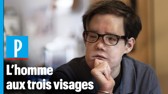 Jérôme Hamon, le seul homme au monde à avoir été greffé deux fois au visage