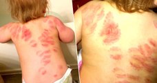 La maman découvre 25 marques de morsures sur le dos de sa petite fille de 15 mois en rentrant de la crèche