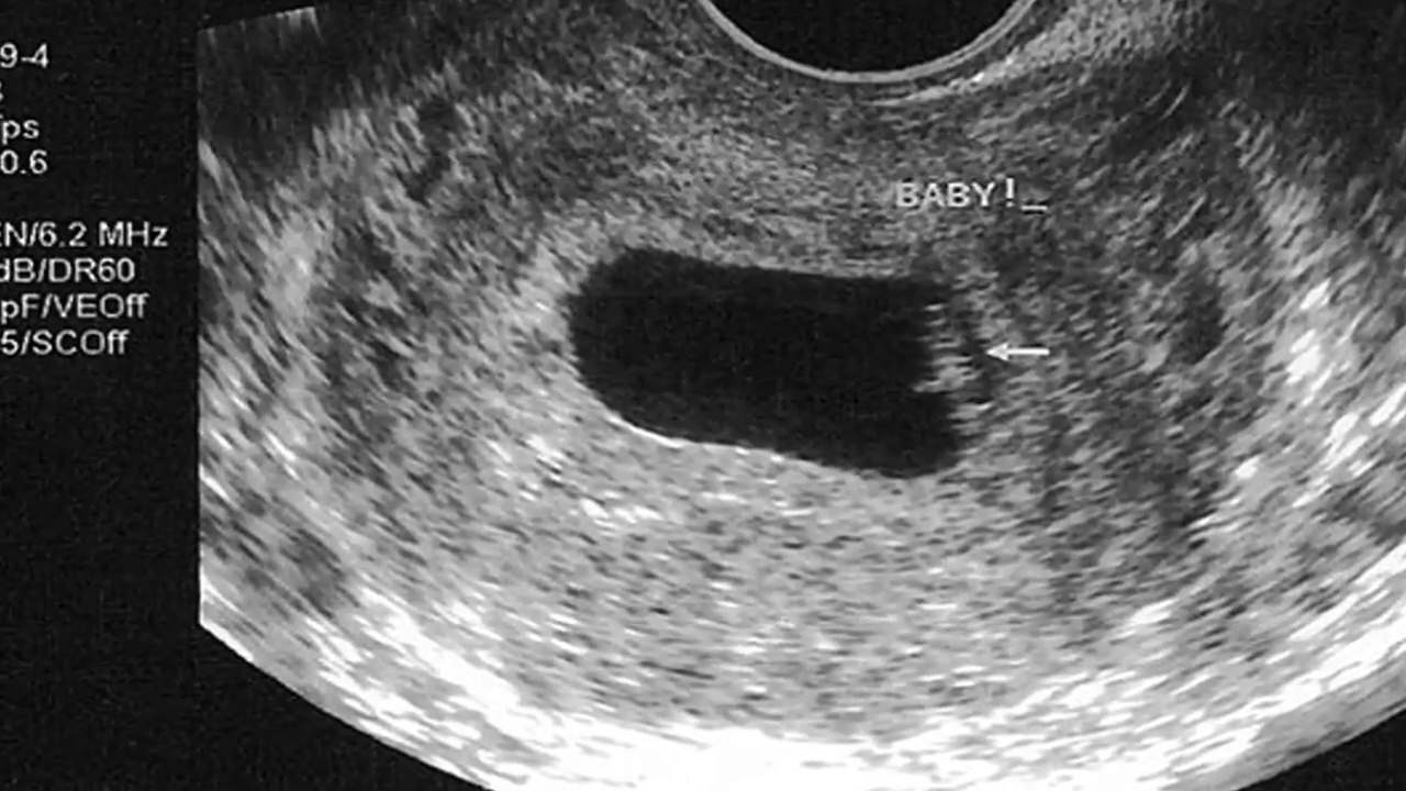 2 HAFTALIK GEBELİK HAMİLELİK İKİ HAFTALIK GEBELİK