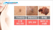 [HEALTH] If you have moles looks like this, suspect cancer,기분 좋은 날20190621