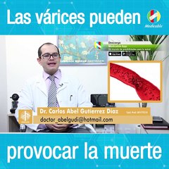 Las várices pueden provocar la muerte