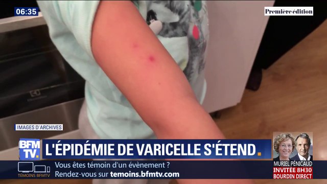 L'épidémie de varicelle continue de s'étendre et touche déjà 12 régions du pays
