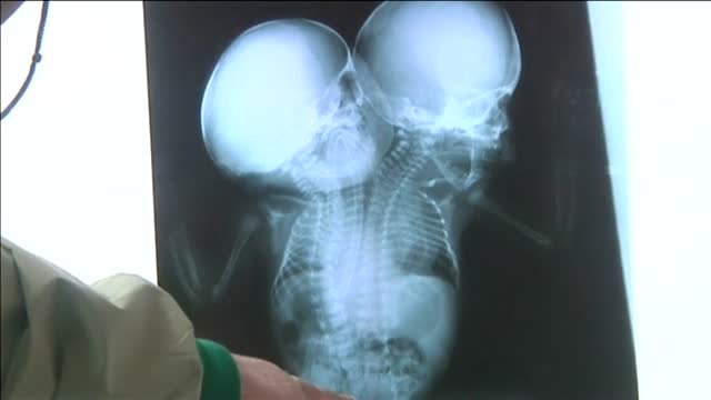 Dos siameses con riesgo de morir necesitan salir urgentemente de Yemen para someterse a una operación en el extranjero