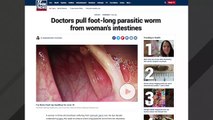 Doctors Find Foot-Long Worm In Woman's Intestines