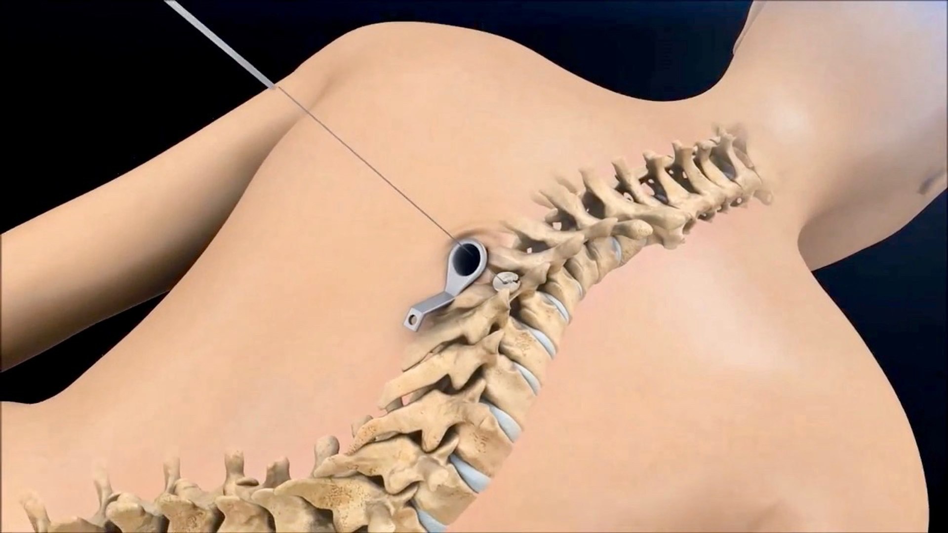 Amazing Surgery To Fix Curved Spine (Scoliosis) - Animation - video  Dailymotion