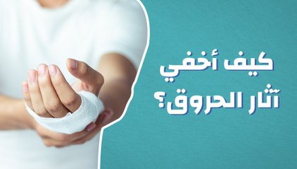 Download Video: كيف أخفي آثار الحروق؟