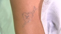 Aumenta la demanda del borrado de tatuajes