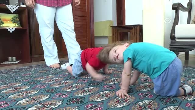 Kafadan yapışık siyam ikizleri bir yaşında - ANTALYA