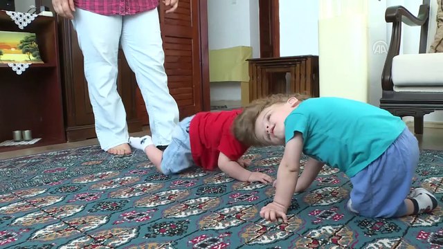 Kafadan yapışık siyam ikizleri bir yaşında - ANTALYA