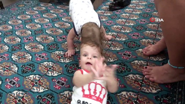 Kafadan yapışık siyam ikizleri 1 yaşında