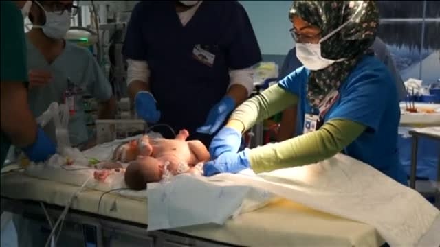 Sobrevive una de las siamesas palestinas separadas en Arabia Saudí