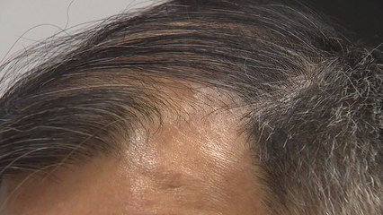 스트레스성 탈모 늘어...운동·규칙적인 수면 도움 / YTN