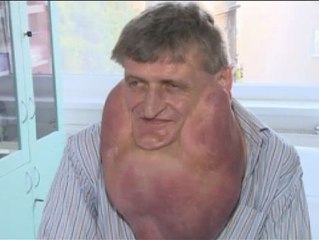 Le quitan un tumor de 6 kilos del cuello