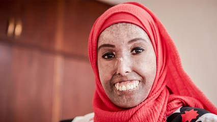 My Hardening Skin Doesn’t Stop Me Being Beautiful | SHAKE MY BEAUTY