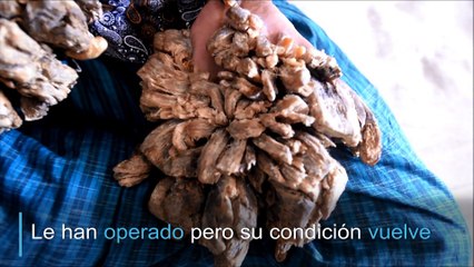 Desesperado, "hombre árbol" pide ser amputado