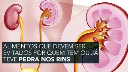 Cuidado: se você já teve pedra nos rins, FUJA destes alimentos!