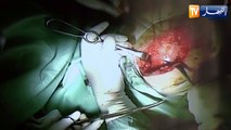 قسنطينة: فريق طبي ينجح في إجراء عملية جراحية لزراعة العظام بمستشفى إبن باديس