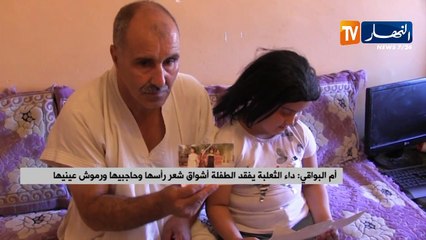 أم البواقي: داء الثعلبة يفقد الطفلة أشواق شعر رأسها وحاجبيها ورموش عينيها