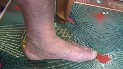 Çaresiz hastalığın pençesinde kıvranıyor