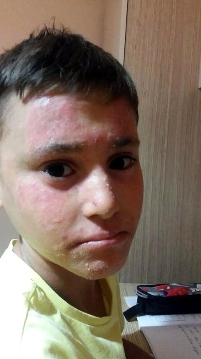 Balık derisi hastası Kayra'nın yardım çığlığı: Para değil krem istiyorum