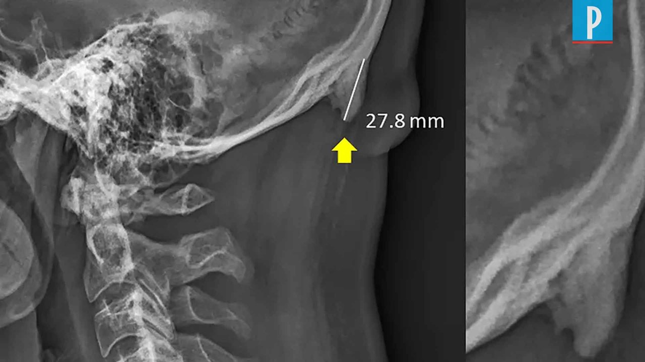 Des cornes sur le crâne des jeunes adultes accros au smartphone ?