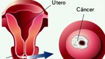 7 sinais que podem indicar câncer no colo do útero