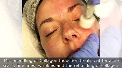 Microneedling in the Denver Region
