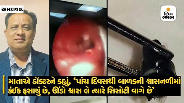 બાળક 5 દિવસ પહેલાં સિસોટી ગળી ગયો, શ્વાસ લે ત્યારે સિસોટી વાગતી, સિવિલમાં થઇ સર્જરી