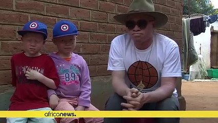 Malawi : un "fils" de Salif Keita au service de la cause albinos