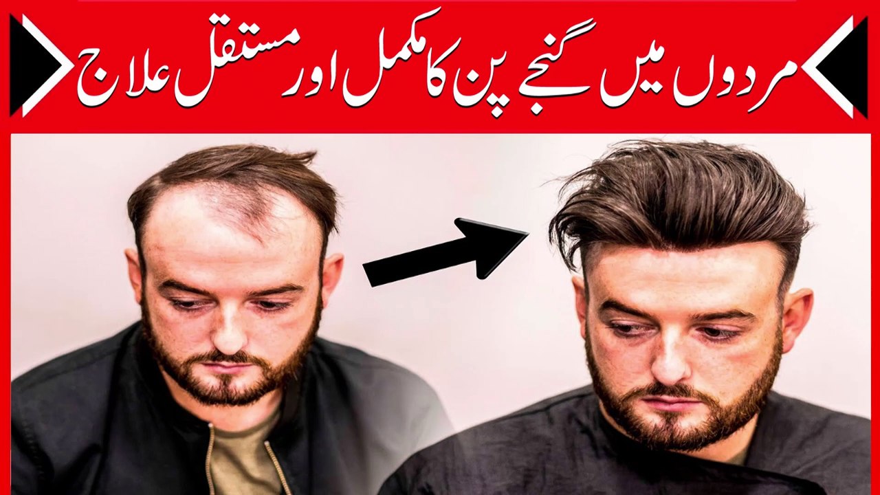 How to Stop Hair Loss for Men || Grow Hair Faster || گنج پن کا مکمل خاتمہ