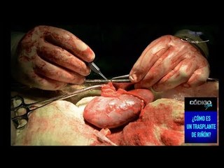 Cuál es el tiempo de vida que otorga un trasplante de riñón