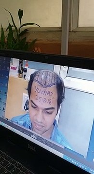 Successful and Satisfied Hair Transplant Result by Sai Cosmetics Pune