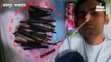 मरीज के पेट से लोहे की 33 चीजें निकलीं