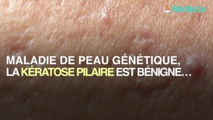 Kératose pilaire : comment se débarrasser de ces petits boutons
