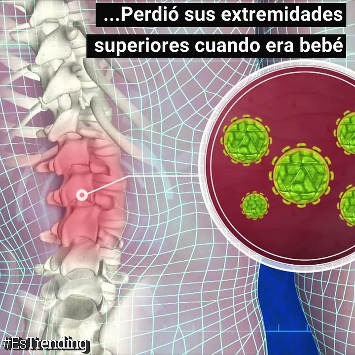 Una meningitis le quitó sus brazos, pero la ciencia le ha dado una nueva oportunidad...