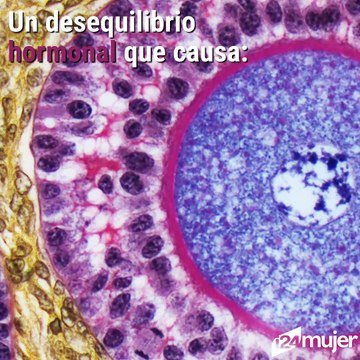 ¿Cómo saber si tengo ovarios poliquísticos?