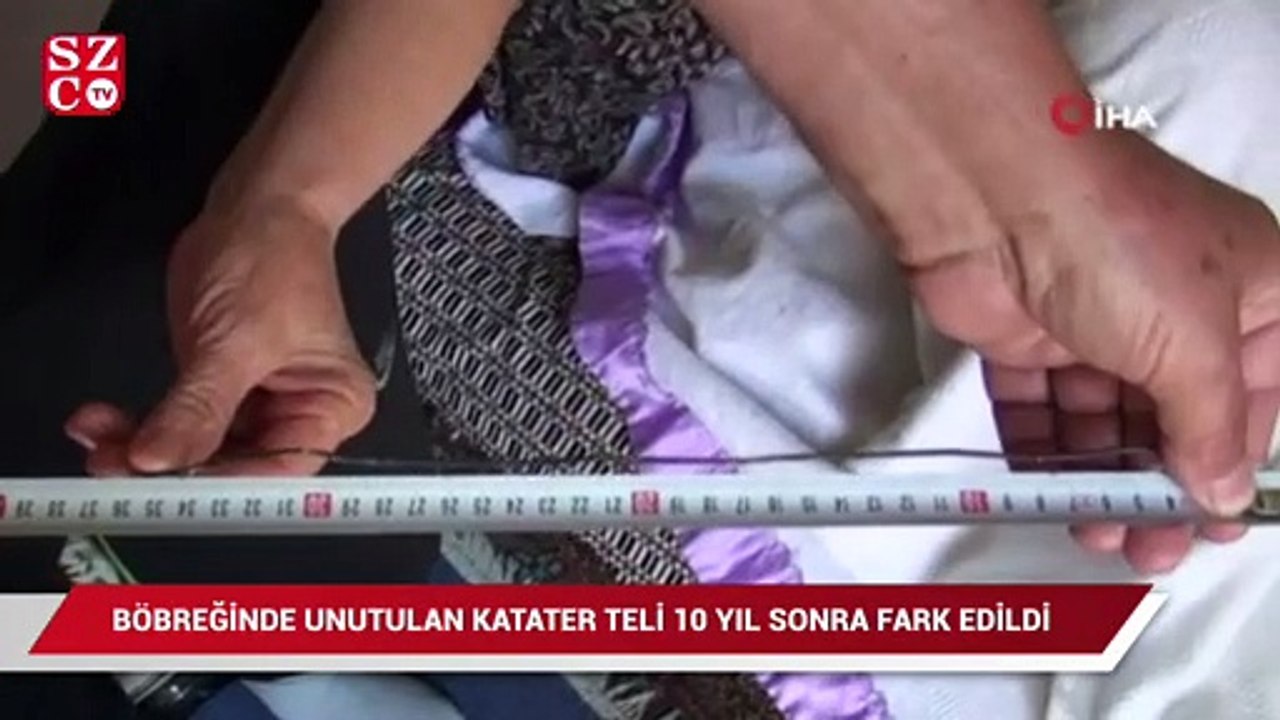 Böbreğinde unutulan katater teli 10 yıl sonra fark edildi