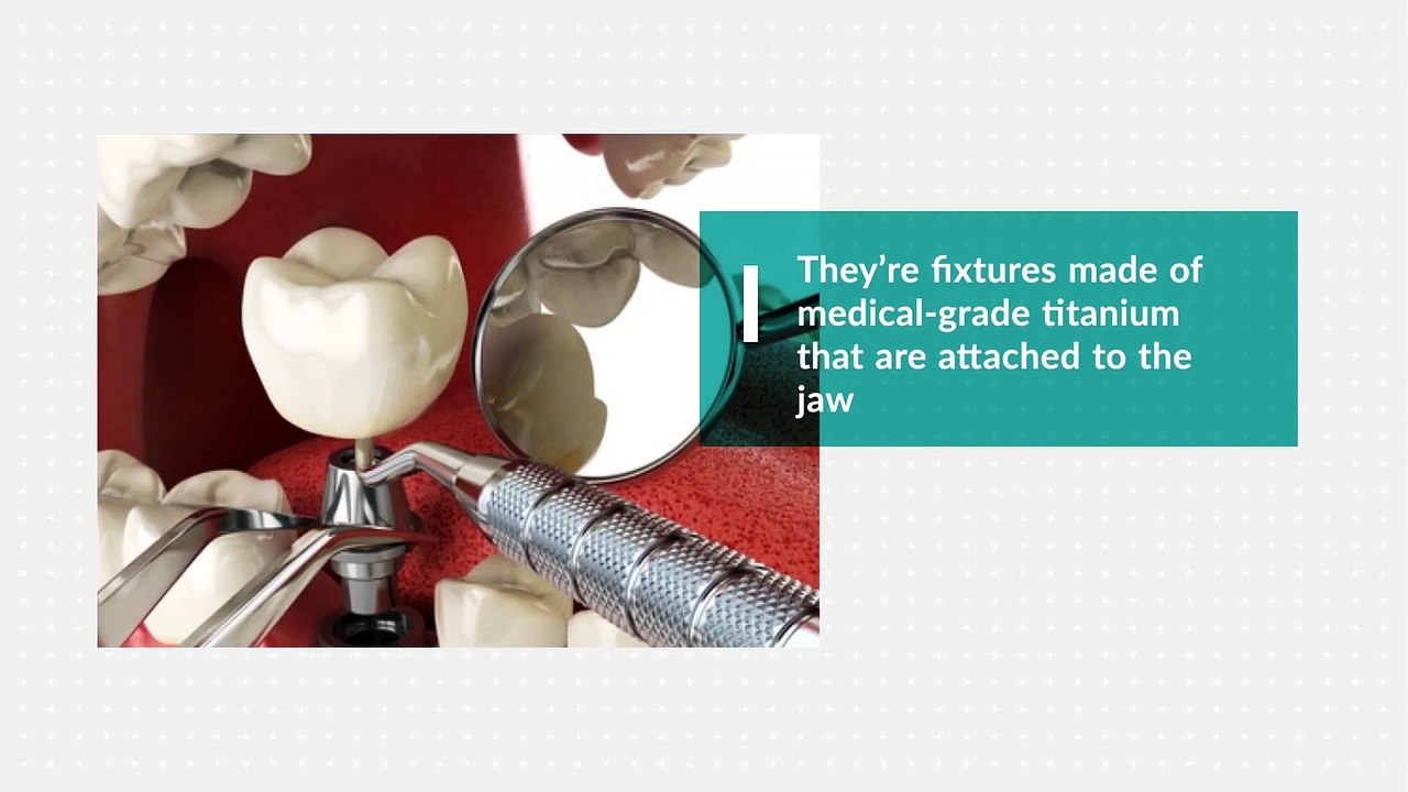 Where Can I Find Dental Implants in the GTA - New Teeth In One Day Dental Clinics