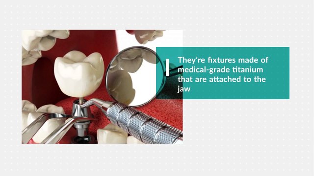 Where Can I Find Dental Implants in the GTA - New Teeth In One Day Dental Clinics