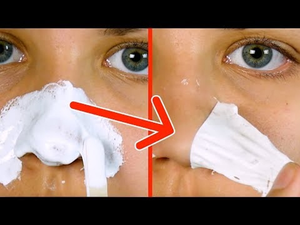 Say Goodbye To Blackheads With A Simple Home Remedy That Works Right Away!