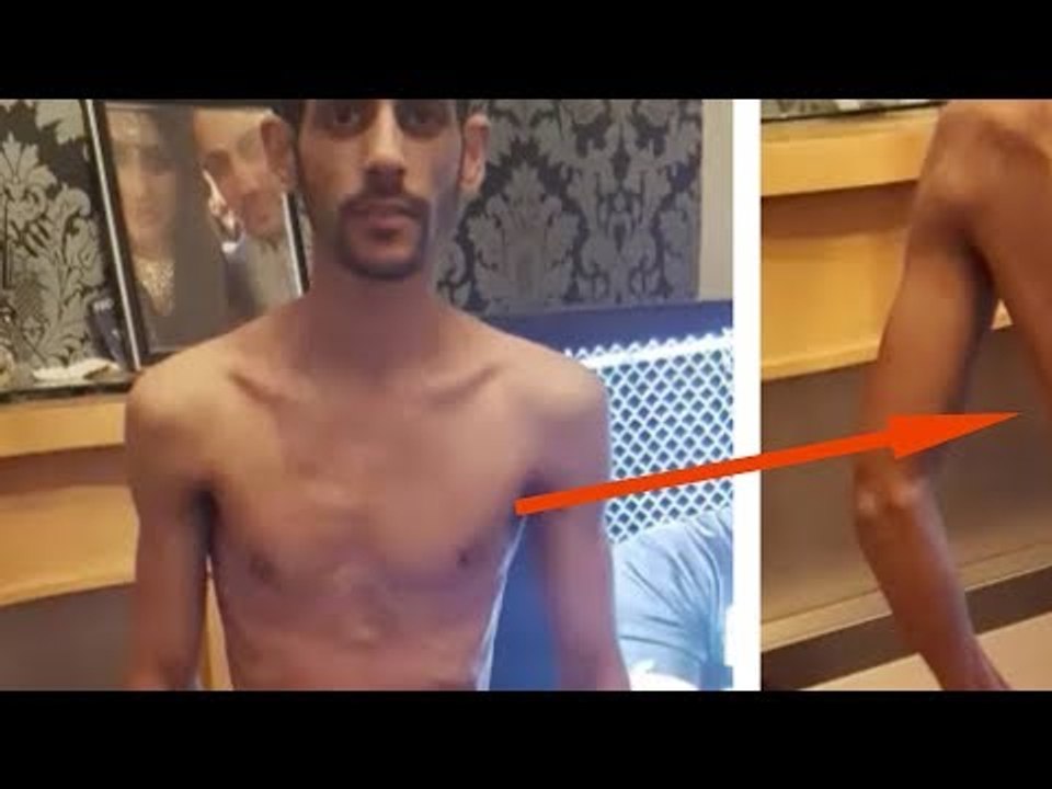Ele era puro osso. Anos depois, ninguém mais o reconhece.