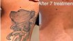 Laser Tattoo Removal Services In Fort Myers | Call - 2393097246 | lasertattooremoval.services