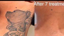 Tattoo Removal Naples FL | Call - 2393097246 | lasertattooremoval.services