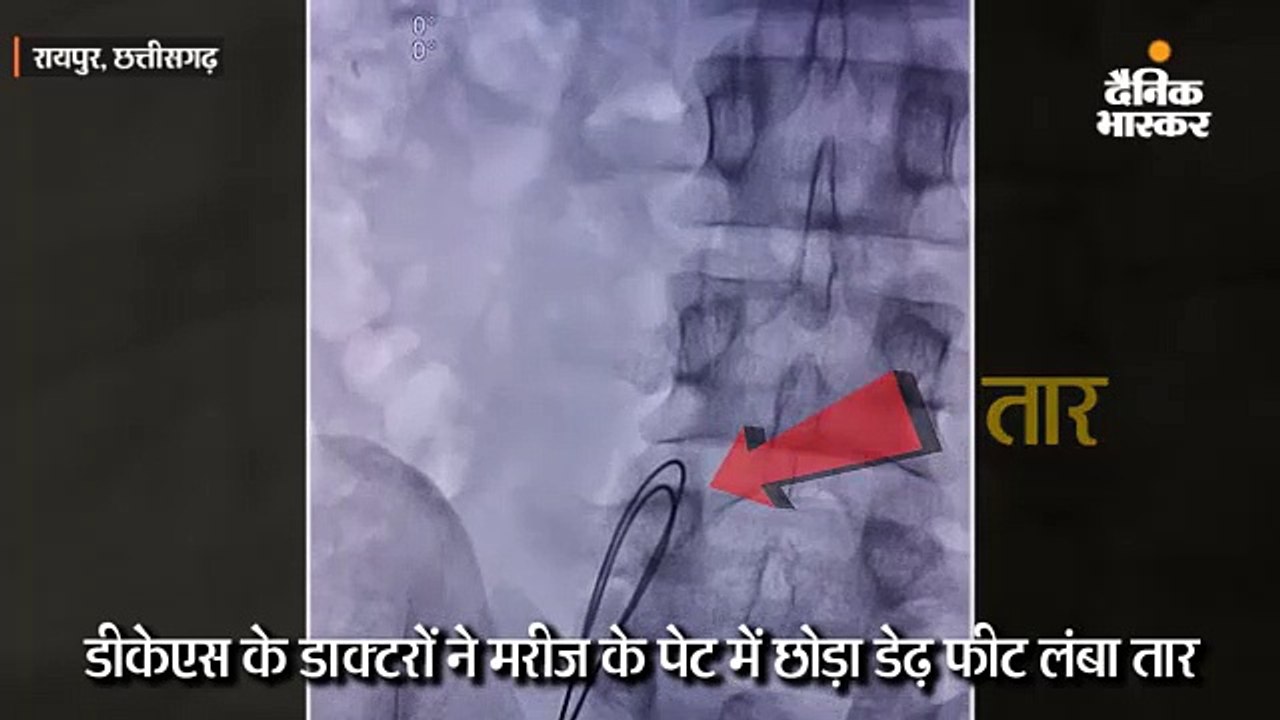 डीकेएस के डाक्टरों ने मरीज के पेट में छोड़ा डेढ़...