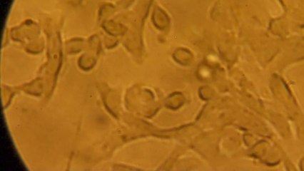 Santé - Microbiote : un nouvel allié anti-cancer !