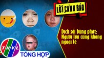 Dịch sởi bùng phát: Người lớn cũng không ngoại lệ